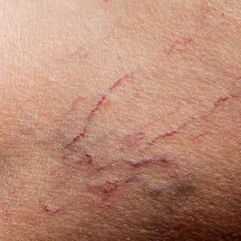 Laser Treatments