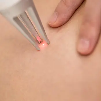Laser Treatments